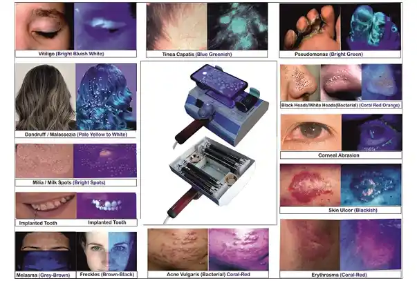 Woods Lamp for Skin Analyzer with Mobile & Remote attachment